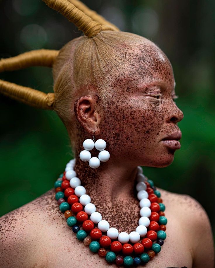 Inclusive Skincare and the Albinism Gap