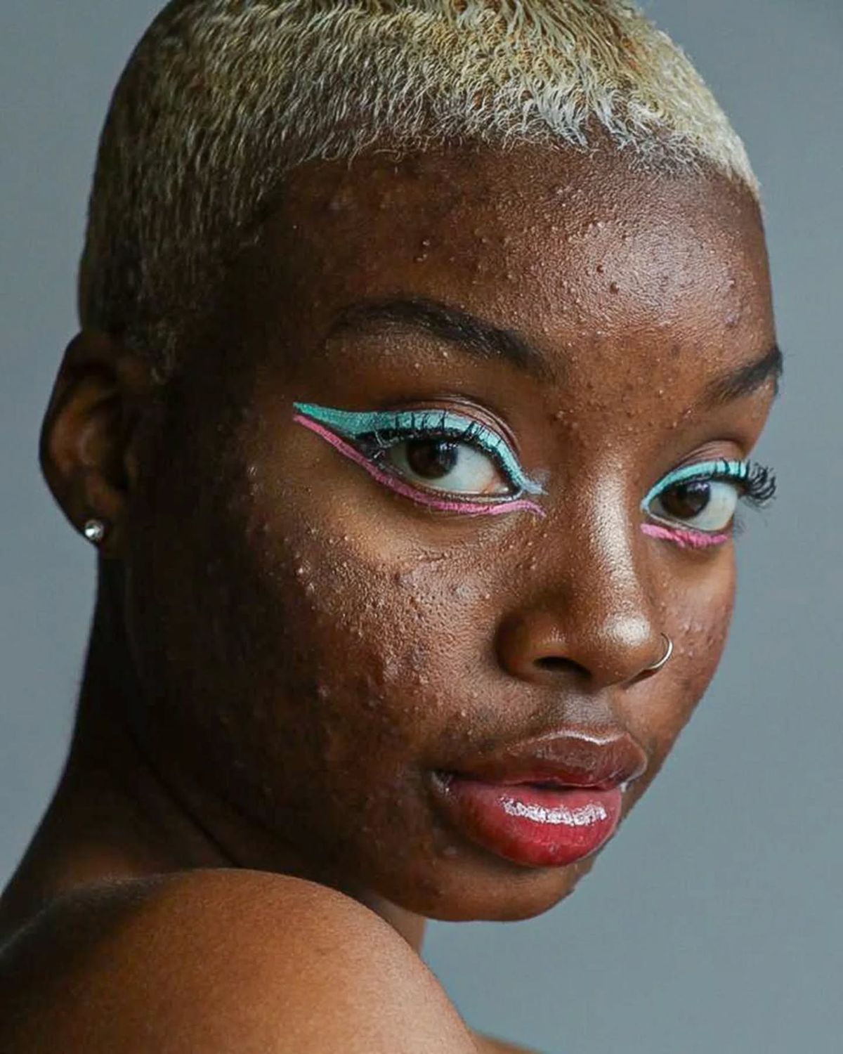 Skin Bleaching Works by Damaging the Skin Barrier