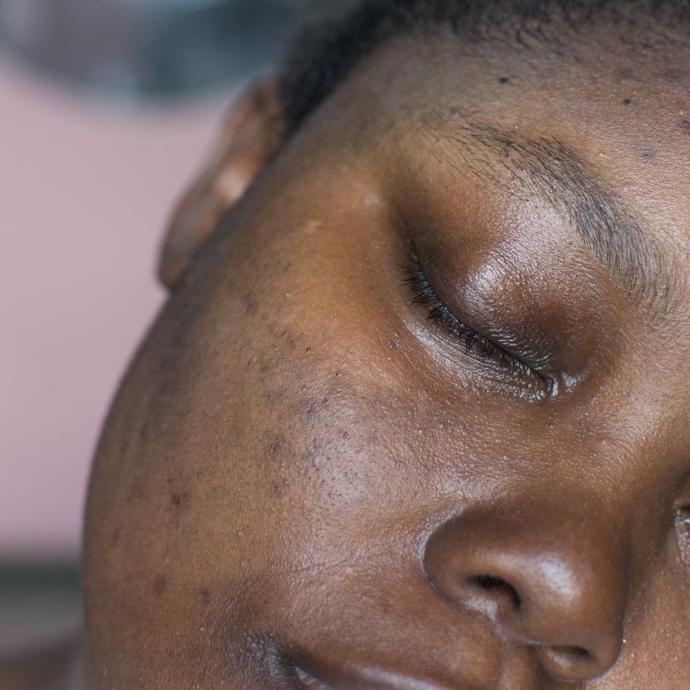 Hyperpigmentation on dark skin, showing uneven skin tone.
