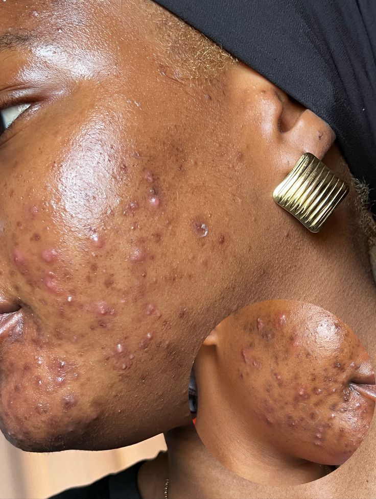 Fungal acne on dark skin caused by humidity and sweat, showing small, uniform bumps.
