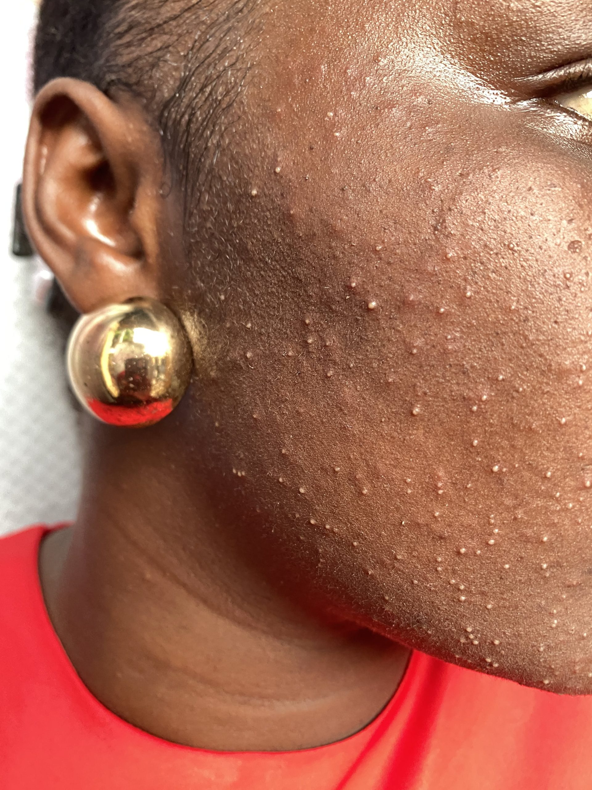 Hard water affects dark skin, leaving dryness and residue after cleansing.