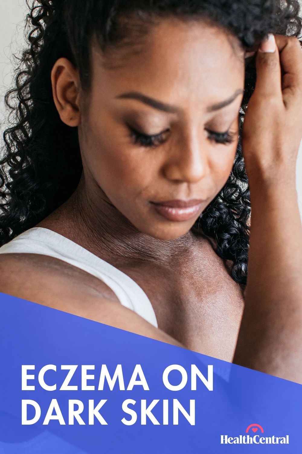 Eczema on dark skin, triggered by heat and sweat, showing irritation and inflammation