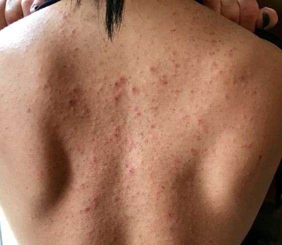 Heat rash on the skin caused by blocked sweat ducts in hot climate conditions
